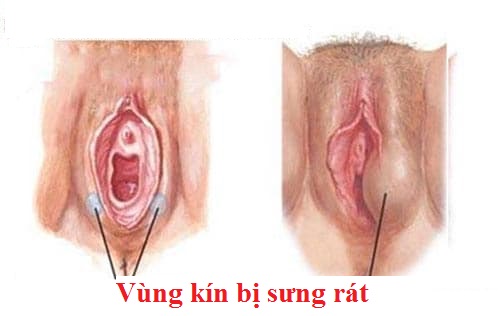 Vùng Kín Ngứa Rát Kéo Dài Có Nguy Hiểm Không