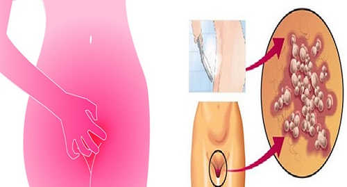 Vùng Kín Ngứa Rát Kéo Dài Có Nguy Hiểm Không