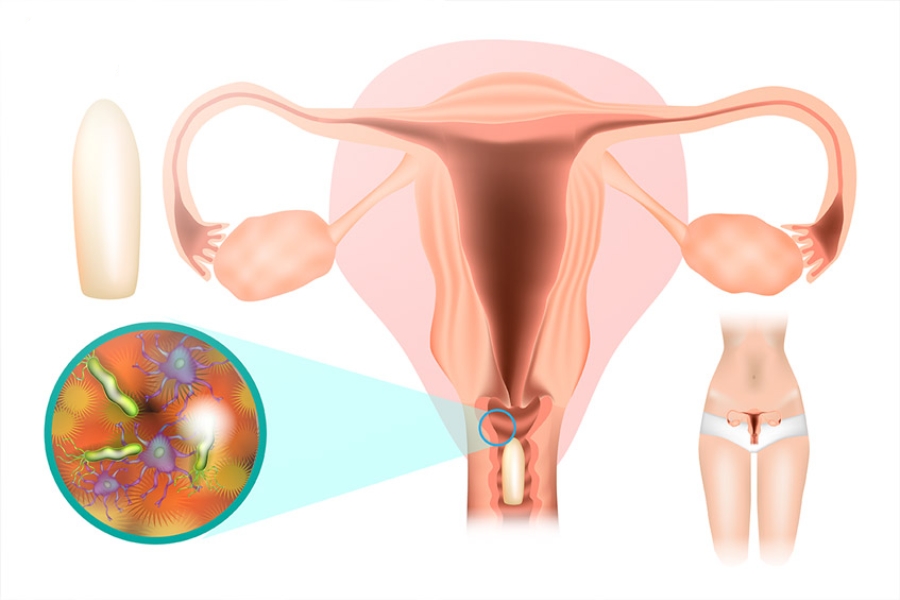 Vùng Kín Thâm Sạm Cảnh Báo Điều Gì Về Sức Khỏe